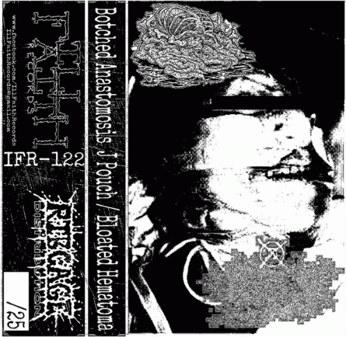 Botched Anastomosis J-Pouch : Botched Anastomosis J-Pouch - Bloated Hematoma